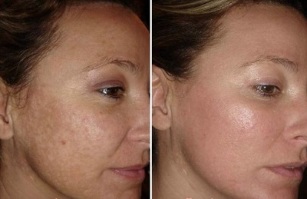fotos de antes y después del rejuvenecimiento de la piel facial con láser